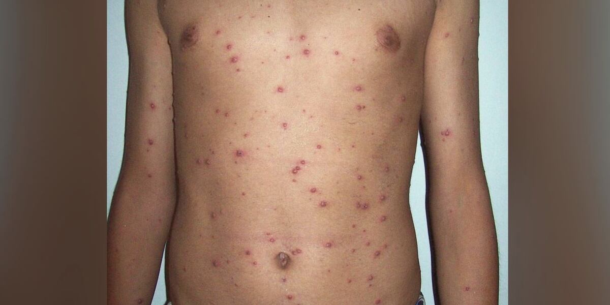 Checkpox Chickenpox on a slight rise in Marquette